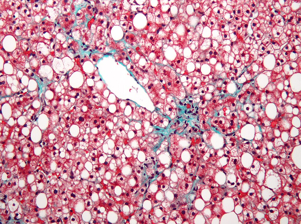 Macrovesicular steatosis in NAFLD/MASLD. Trichrome stain: large lipid vacuoles (white) displace hepatocyte nuclei; pericellular fibrosis in blue-green; central vein centre-right.