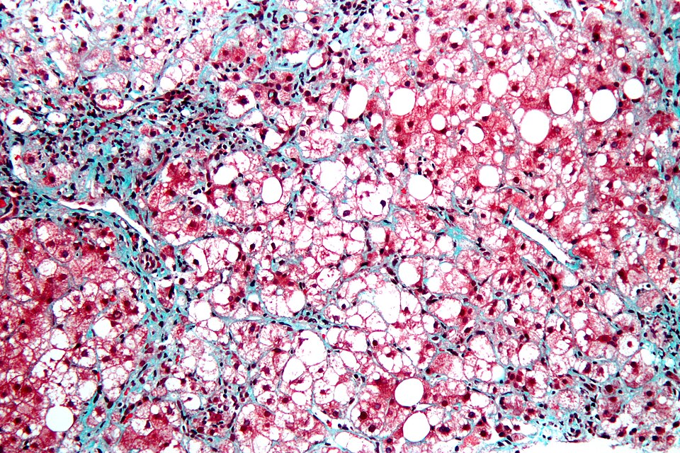 Steatohepatitis (MASH). Trichrome stain at high magnification: ballooned hepatocytes, microvesicular and macrovesicular steatosis, lobular inflammation, chicken-wire pericellular fibrosis.